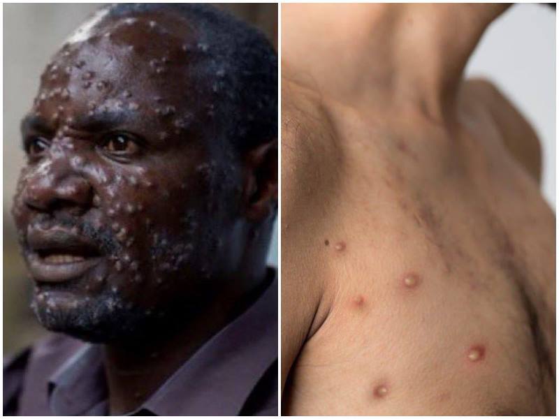 Mpox trauma pandemik global bermula